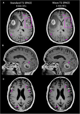 Accelerated Post-contrast Wave-CAIPI T1 SPACE Achieves Equivalent Diagnostic Performance Compared With Standard T1 SPACE for the Detection of Brain Metastases in Clinical 3T MRI